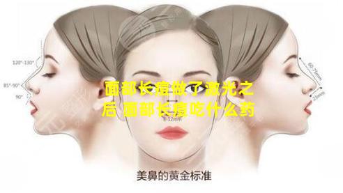 面部长痘做了激光之后 面部长痘吃什么药